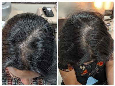 Female Pattern Hair Loss