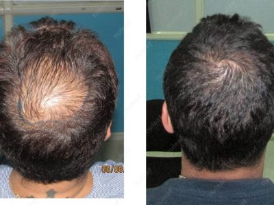 Crown area hair transplant at Nuleaf Pune