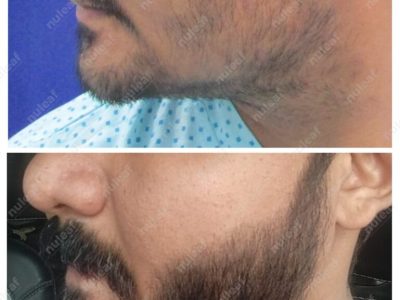 Beard Hair Transplant