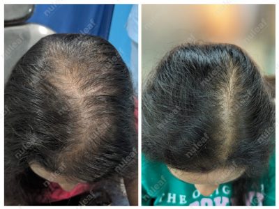 Female Pattern Hair Loss
