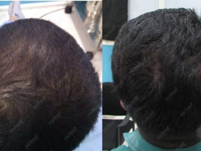 Crown area hair transplant at Nuleaf Pune