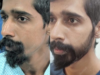 Beard Hair Transplant