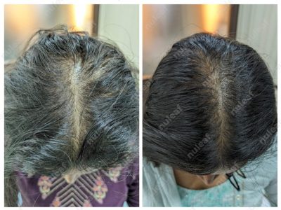 Female Pattern Hair Loss