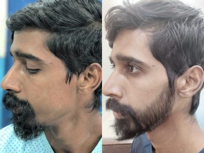 Beard Hair Transplant