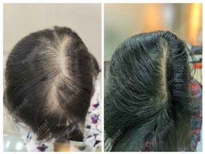 Female Pattern Hair Loss