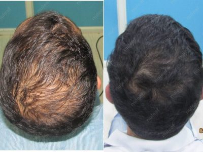Crown area hair transplant at Nuleaf Pune