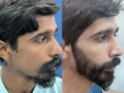 Beard Hair Transplant