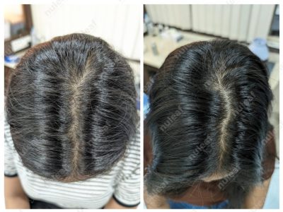 Female Pattern Hair Loss