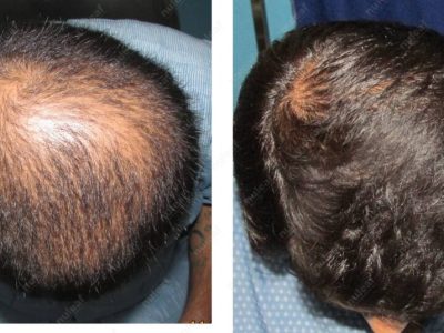 Crown area hair transplant at Nuleaf Pune