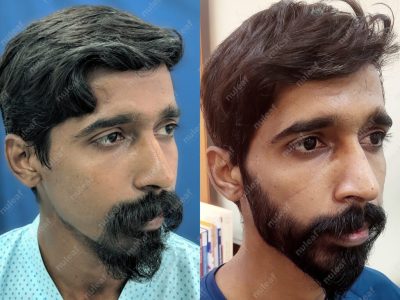 Beard Hair Transplant