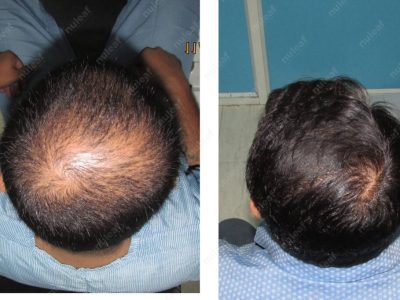 Crown area hair transplant at Nuleaf Pune