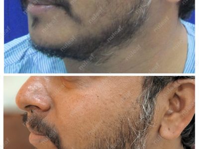 Beard Hair Transplant