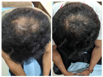PRP Hair Treatment Results in Pune