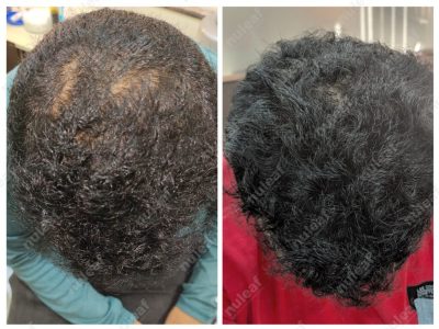 PRP Hair Treatment Results in Pune