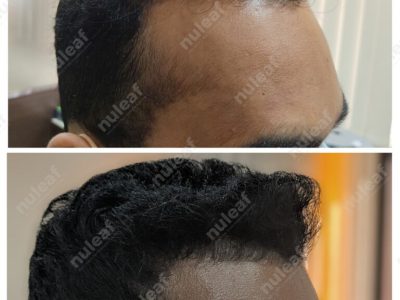 PRP Hair Treatment Results in Pune