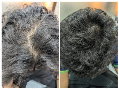PRP Hair Treatment Results in Pune
