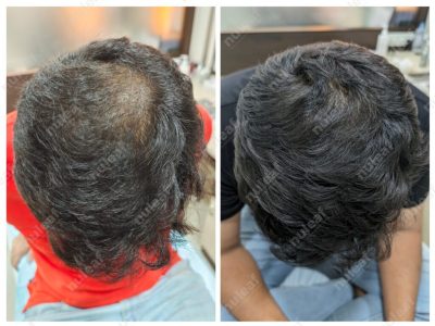 PRP Hair Treatment Results in Pune