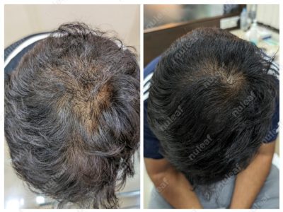 PRP Hair Treatment Results in Pune