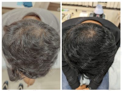 PRP Hair Treatment Results in Pune