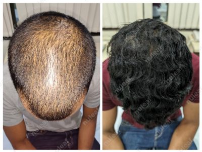 PRP Hair Treatment Results in Pune
