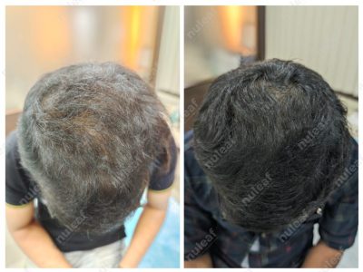 PRP Hair Treatment Results in Pune