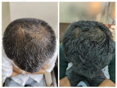 PRP Hair Treatment Results in Pune