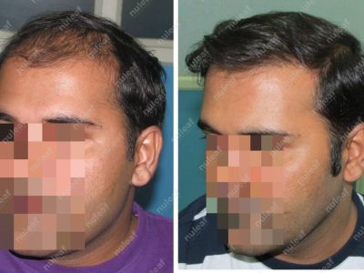 Frontal Area Hair Transplant Results in Pune
