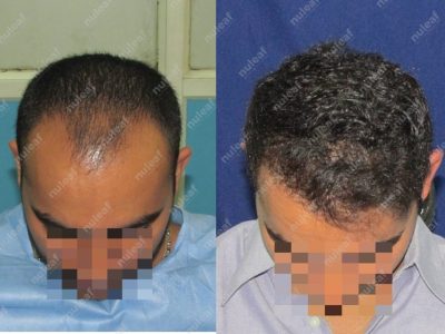 Frontal Area Hair Transplant in Pune