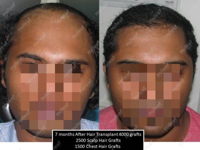 Frontal Area Hair Transplant in Pune