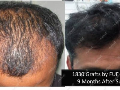 Frontal Area Hair Transplant in Pune