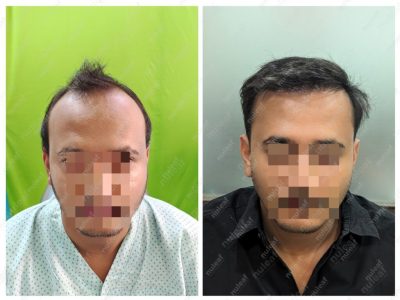 Frontal Area Hair Transplant in Pune