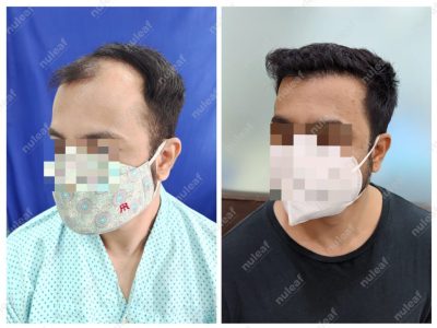Frontal Area Hair Transplant in Pune
