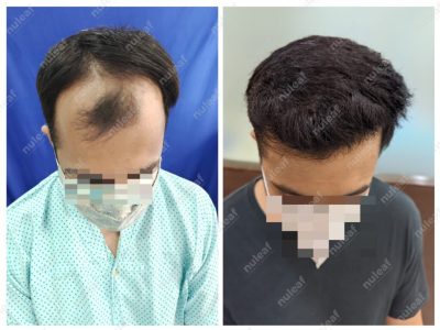 Frontal Area Hair Transplant in Pune