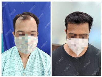 Frontal Area Hair Transplant in Pune