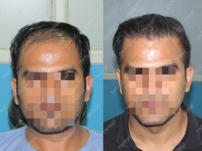 Frontal Area Hair Transplant Results in Pune