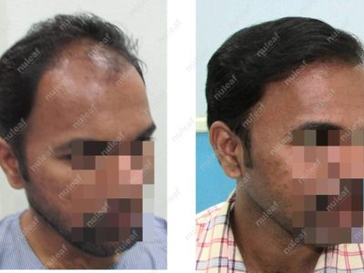 Frontal Area Hair Transplant in Pune