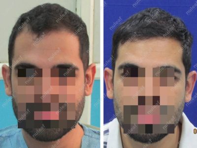 Frontal Area Hair Transplant in Pune
