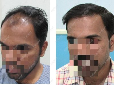 Frontal Area Hair Transplant in Pune