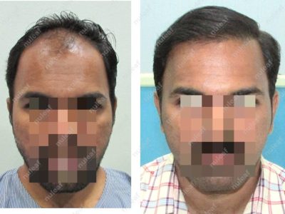 Frontal Area Hair Transplant in Pune