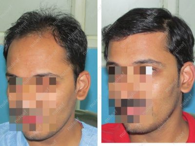 Frontal Area Hair Transplant in Pune