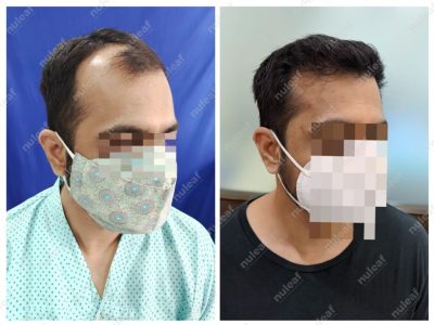 Frontal Area Hair Transplant in Pune
