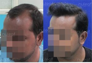 High Density Hair Transplant