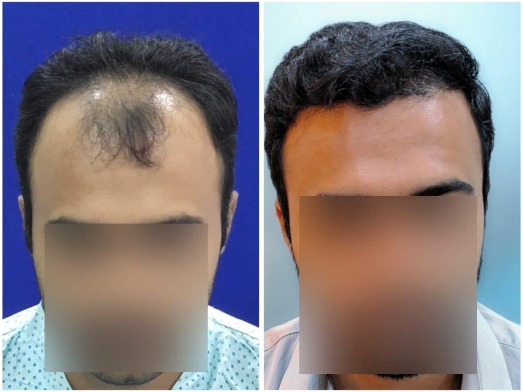 Hair Transplant Results in Pune