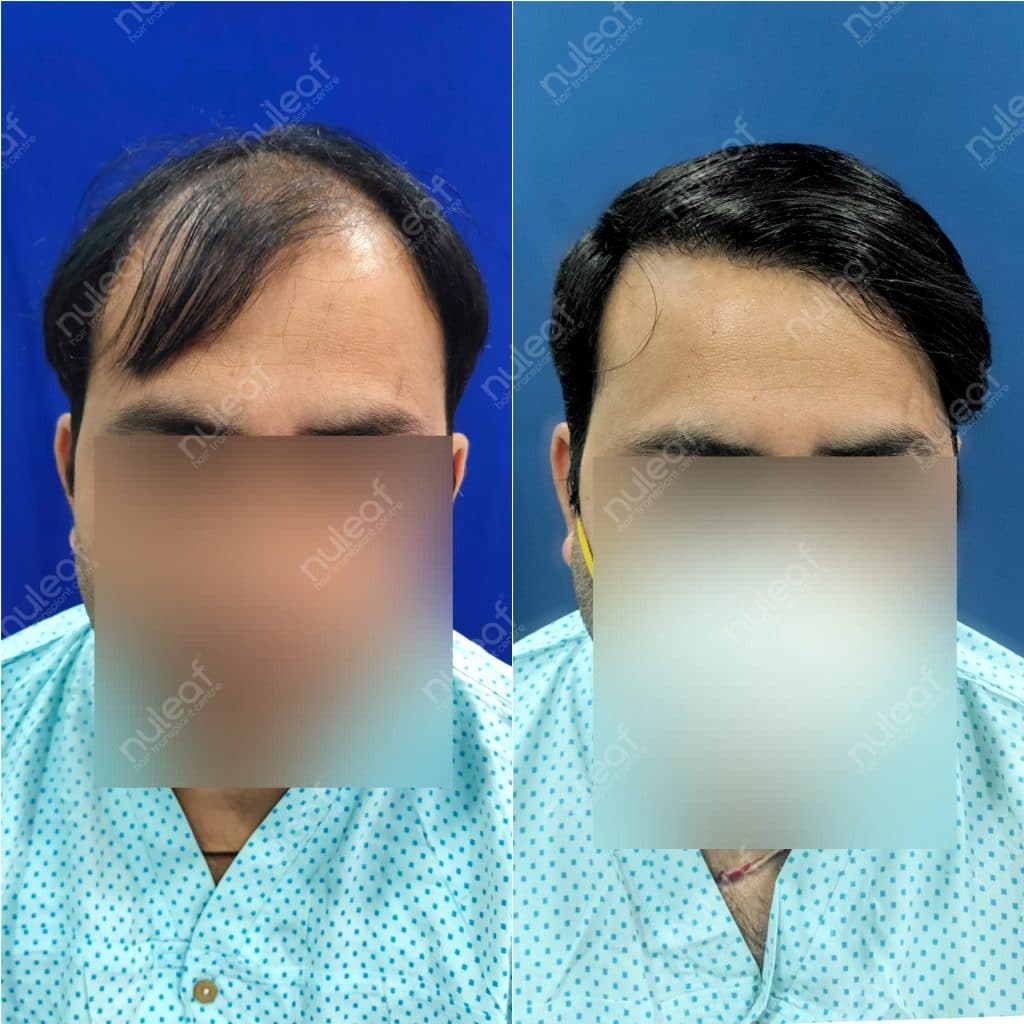 Hair Transplant Results in Pune