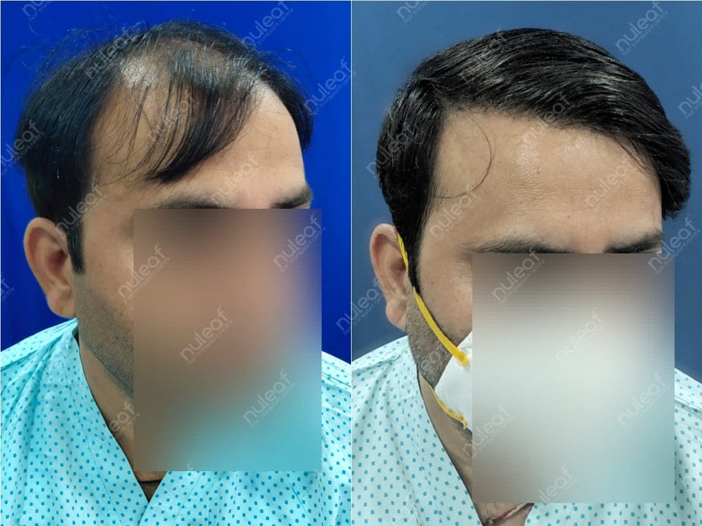 Hair Transplant Results in Pune