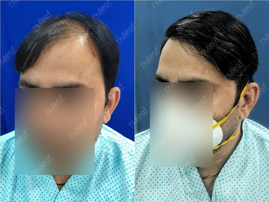 Hair Transplant Results in Pune