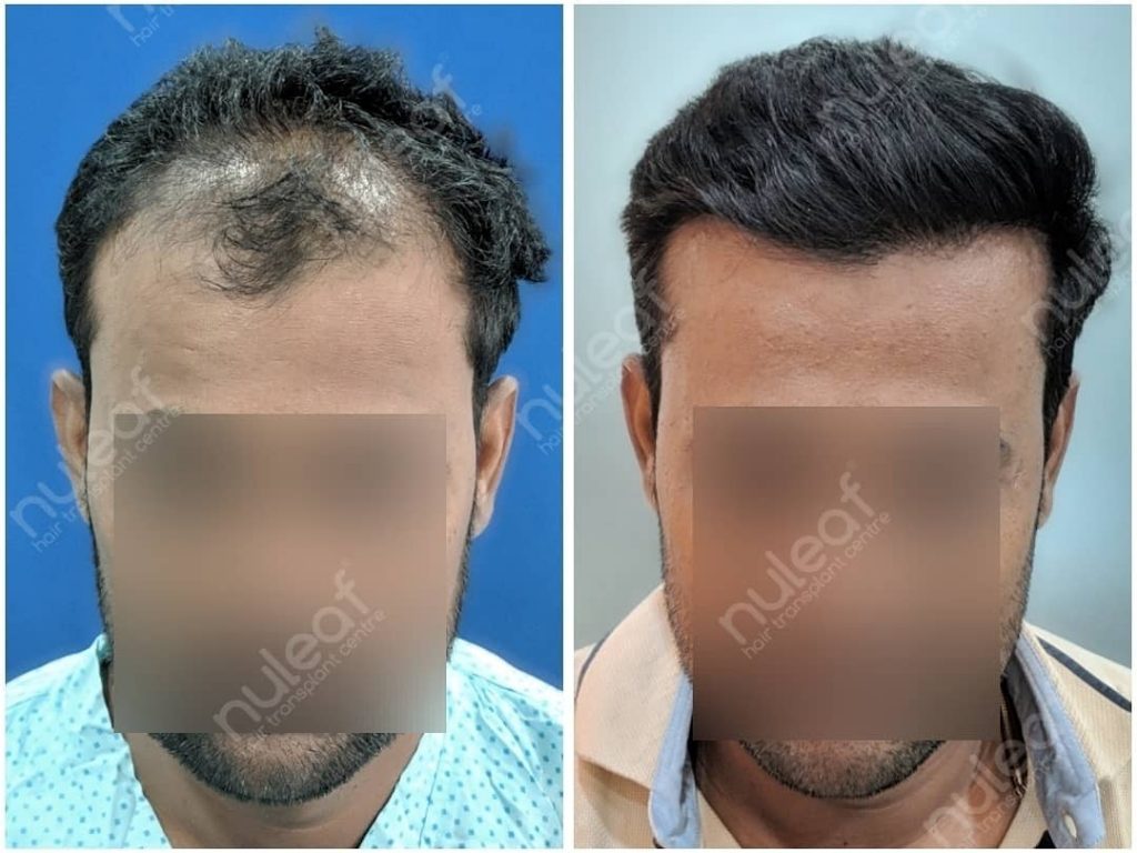 Best hair transplant in Pune