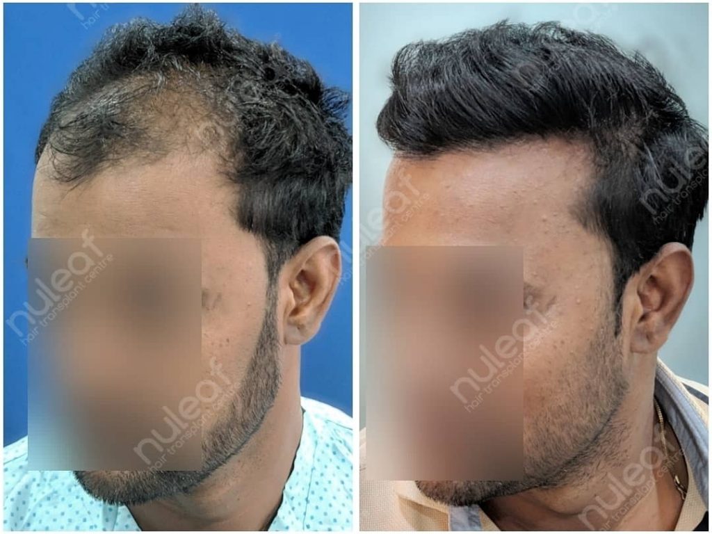 Hair Transplant done by Dr. Tushar Kshirsagar