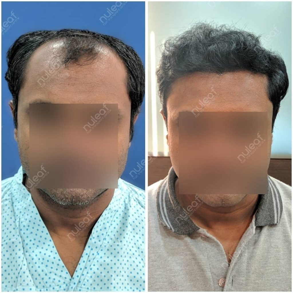 Hair Transplant Results