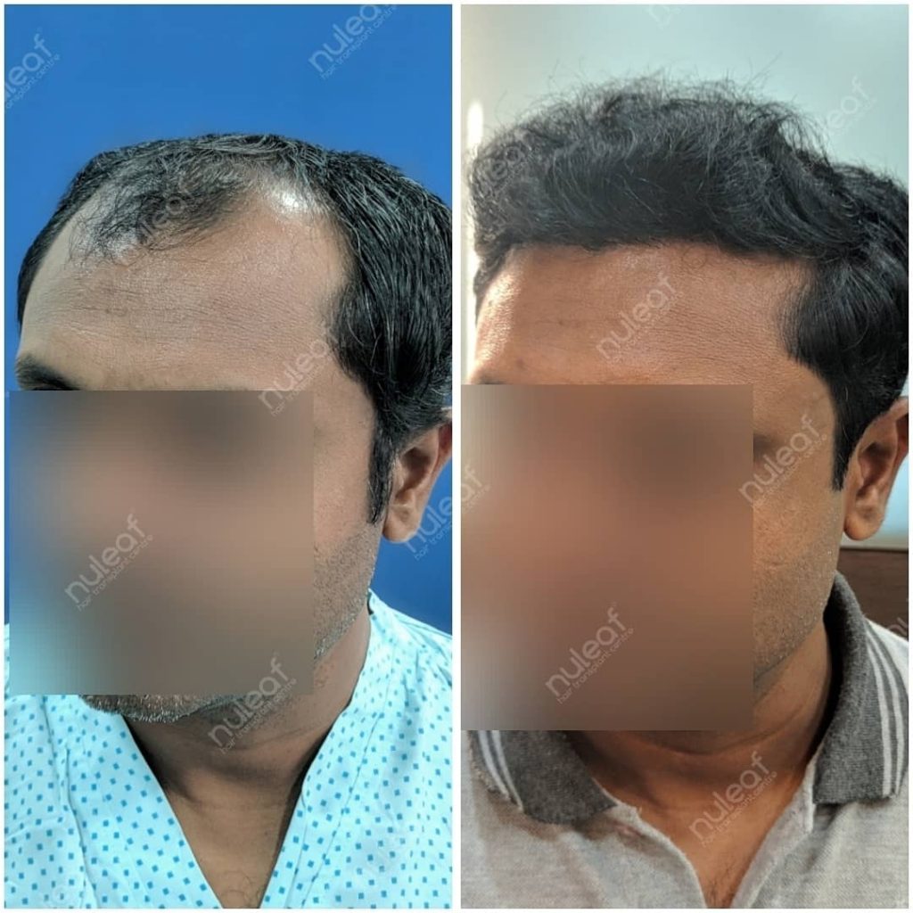 Hair Transplant in Pune